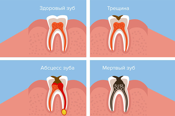 Имплантация одного зуба 🦷 ✓Цены ✓Фото 