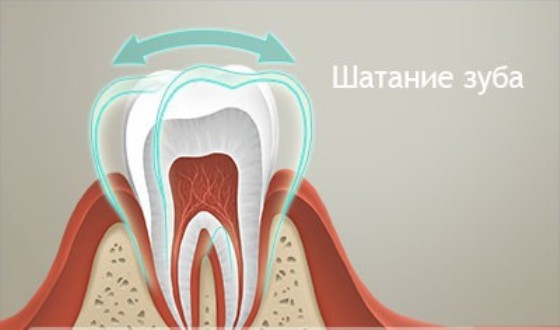 Удаление зубов мудрости в Москве