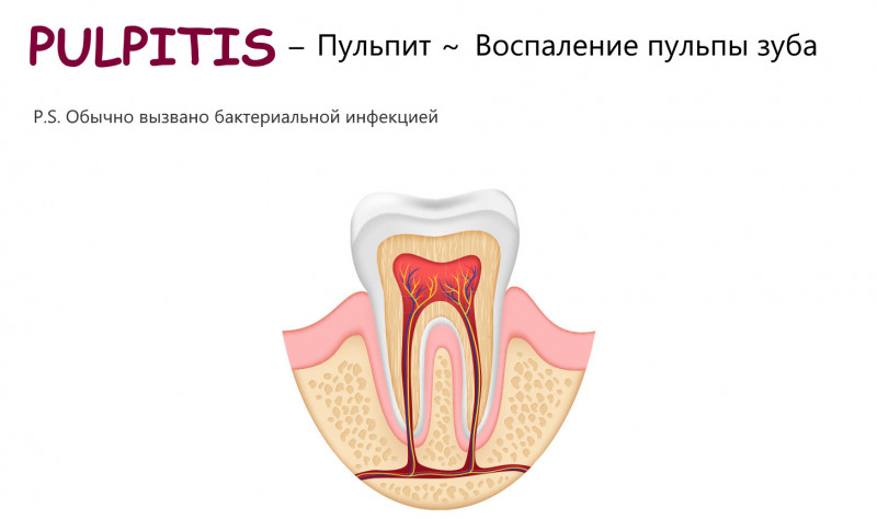 Восстановление сломанного зуба в Санкт 