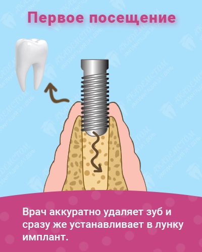 Имплантация зубов – цена в Москве от 30 